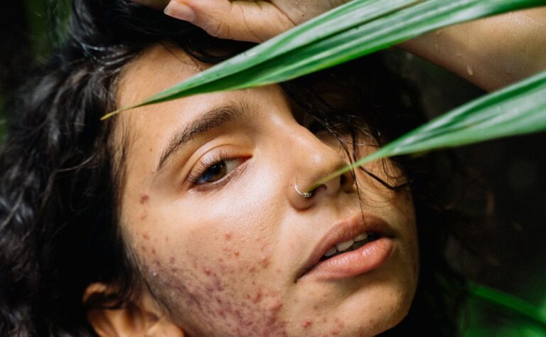 cbd contra el acne